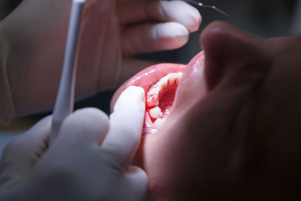 Comment gérer son stress avant l’opération des dents de sagesse ?