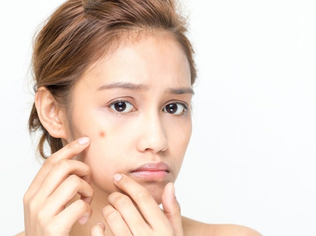 Stress et poussée d’acné : quelle solution pour avoir une belle peau ?