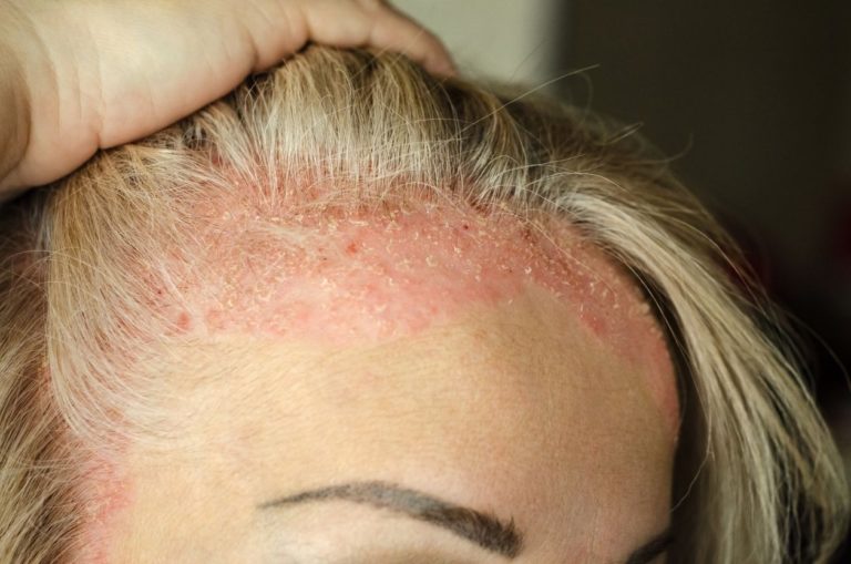 Stress et psoriasis du cuir chevelu quelle solution